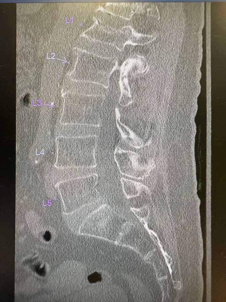 Lspinexray