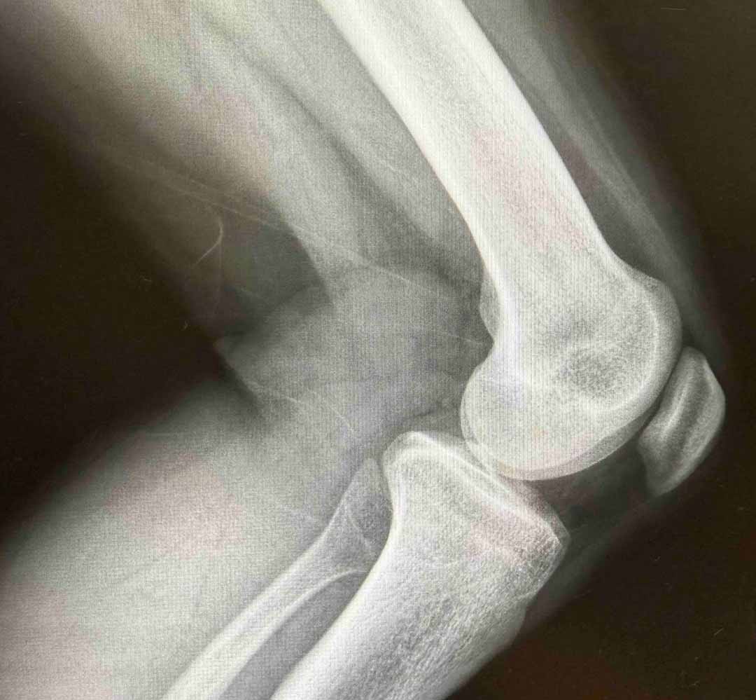 Knee x-ray
