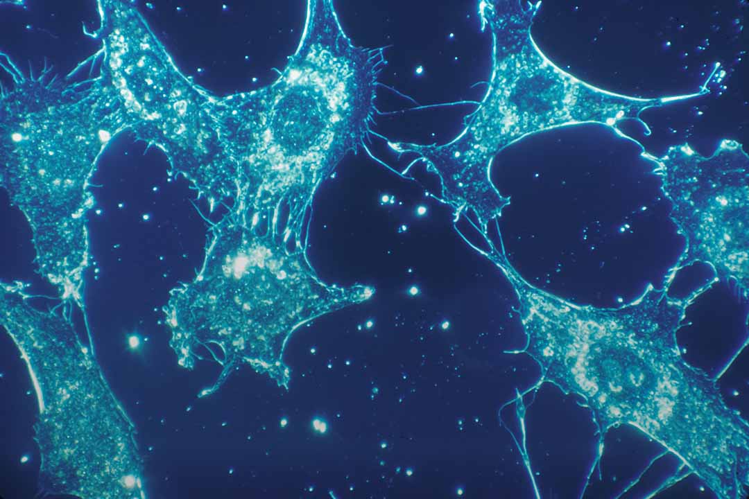 Microscopic view of cancer cell